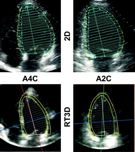 mdmath lv mass|Left Ventricular Mass .